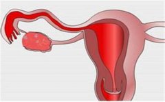 输卵管疾病动不动就导致不孕
