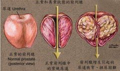 前列腺炎和前列腺肿大是一回事吗？